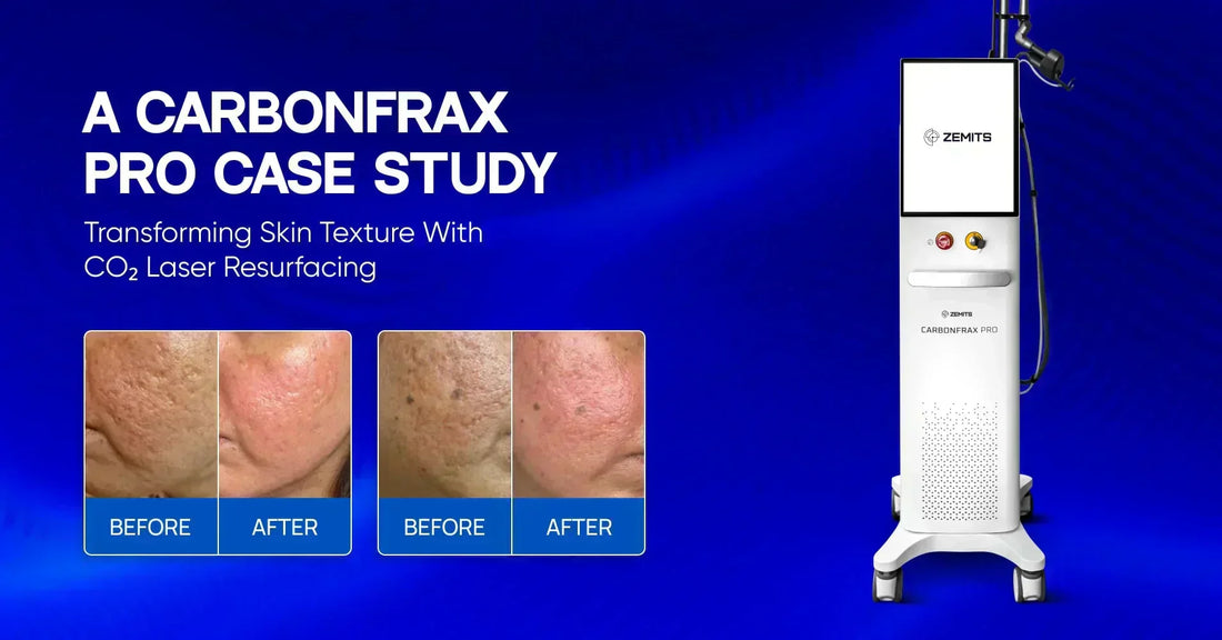 Transforming Skin Texture With CO₂ Laser Resurfacing: A CarbonFrax Pro Case Study