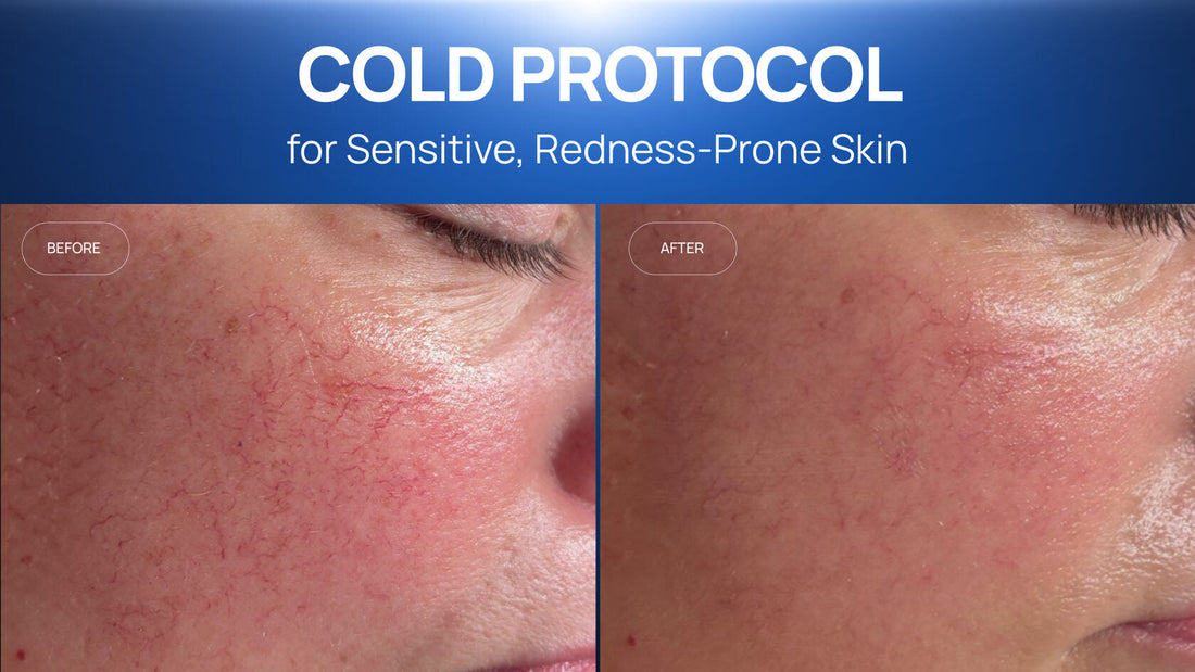 How a Cold Plasma and Cooling Protocol Calmed Sensitive,  Redness-Prone Skin in Two Sessions