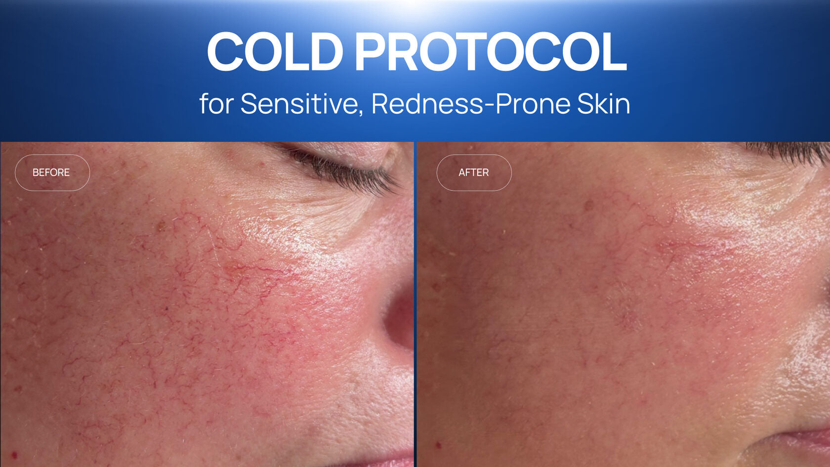 How a Cold Plasma and Cooling Protocol Calmed Sensitive,  Redness-Prone Skin in Two Sessions