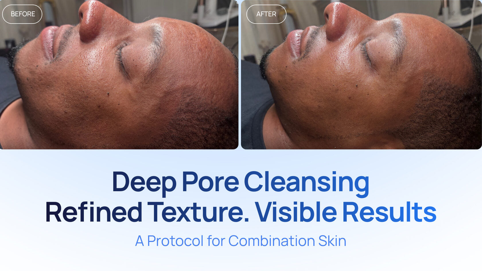 A Deep Pore-Cleansing Protocol for Combination Skin: A 2-Session Case Study