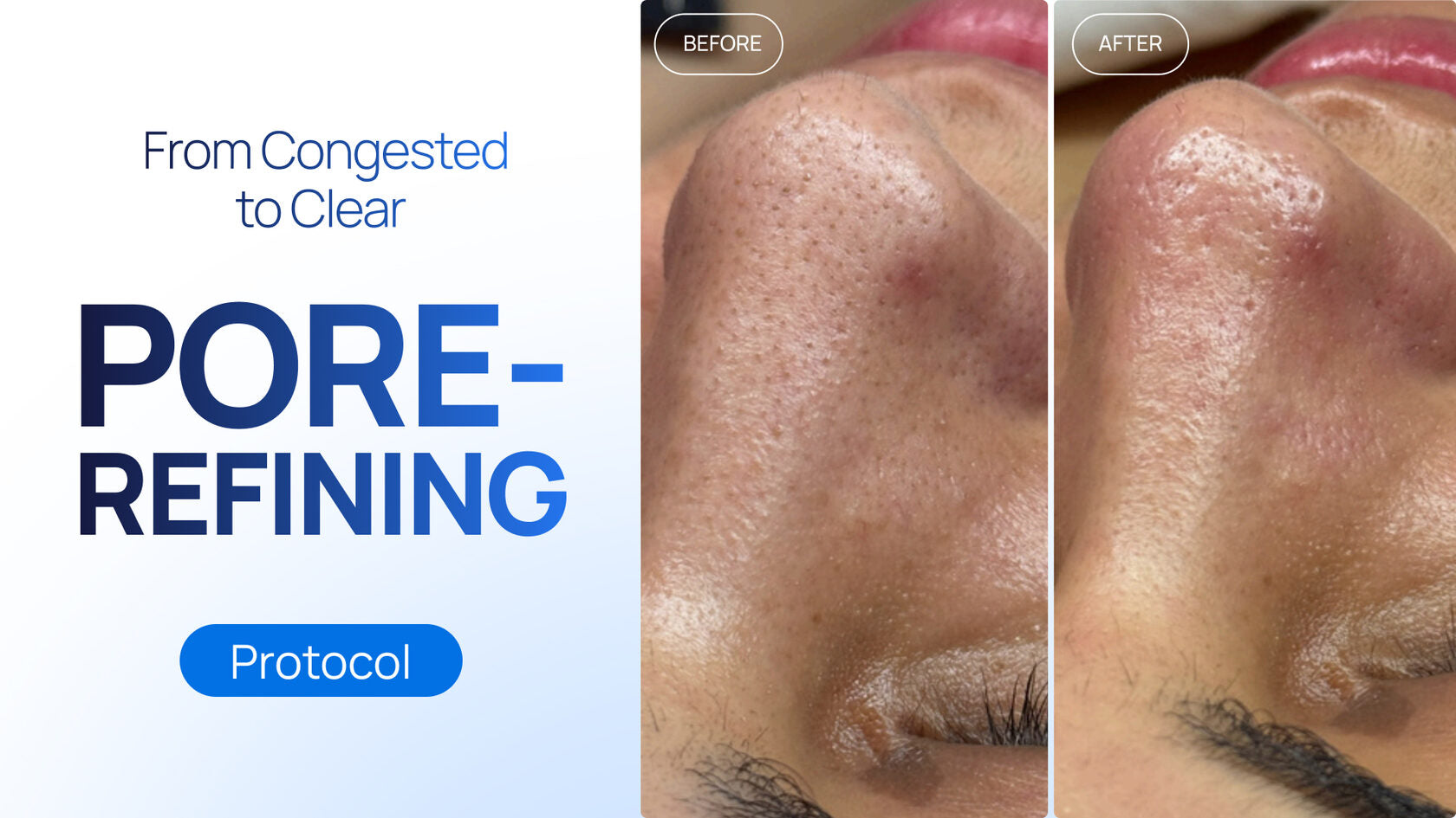 From Congested to Clear: A Pore-Refining Protocol on the Zemits Verstand HD Pro