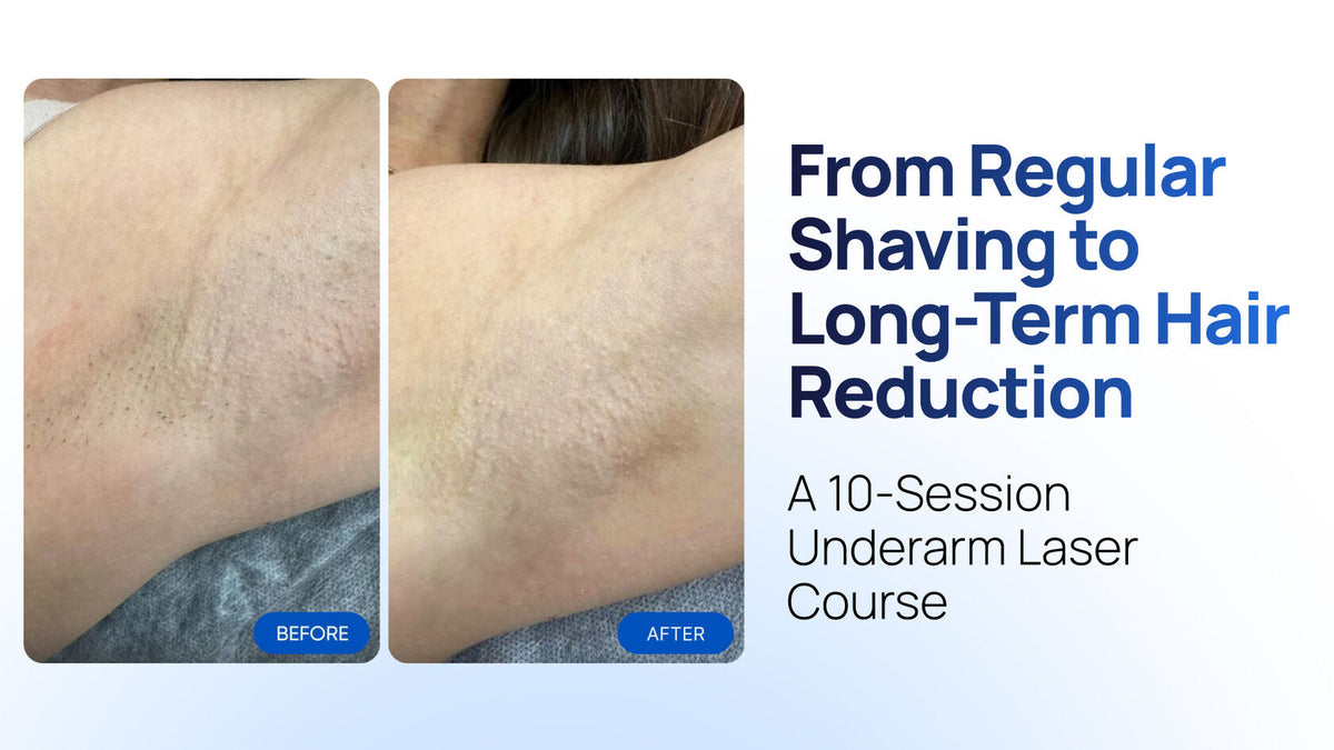 From Regular Shaving to Long-Term Hair Reduction: A 10-Session Underarm Case on the Zemits Quidion Lite Pro