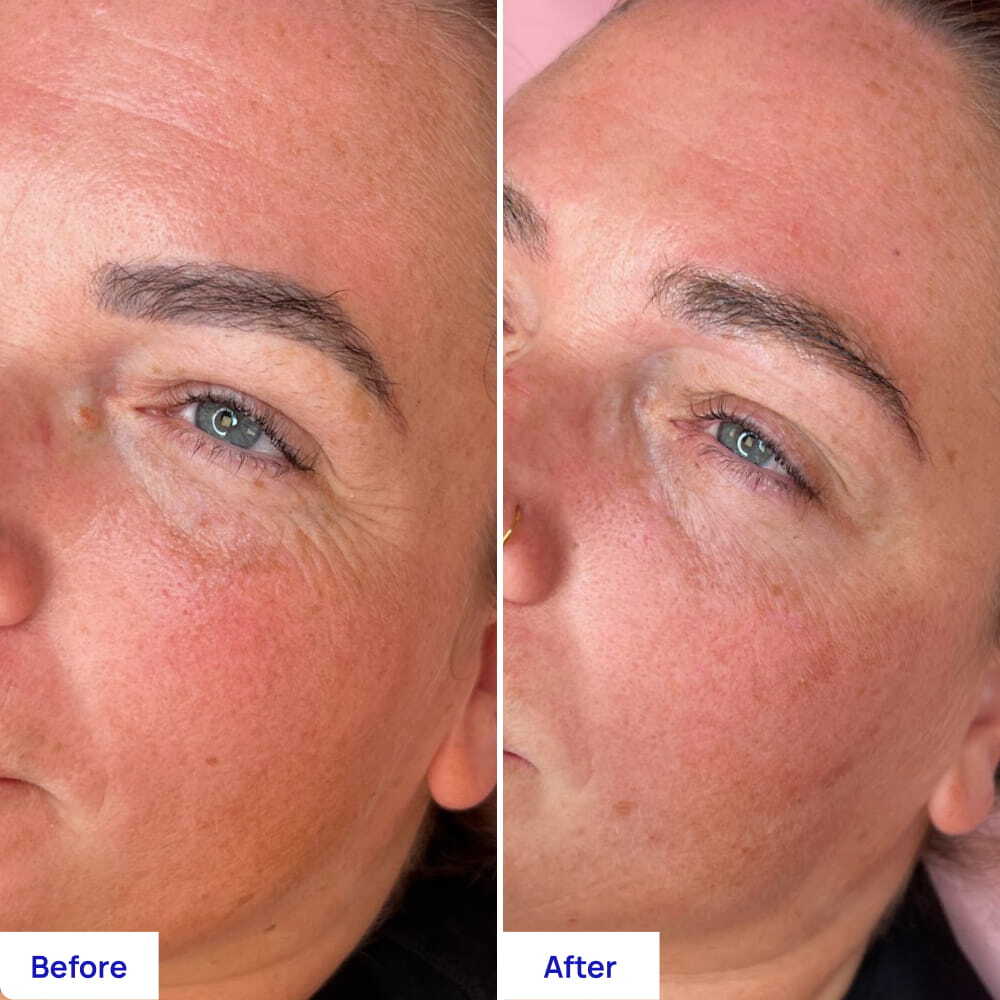 Before After Slide 1