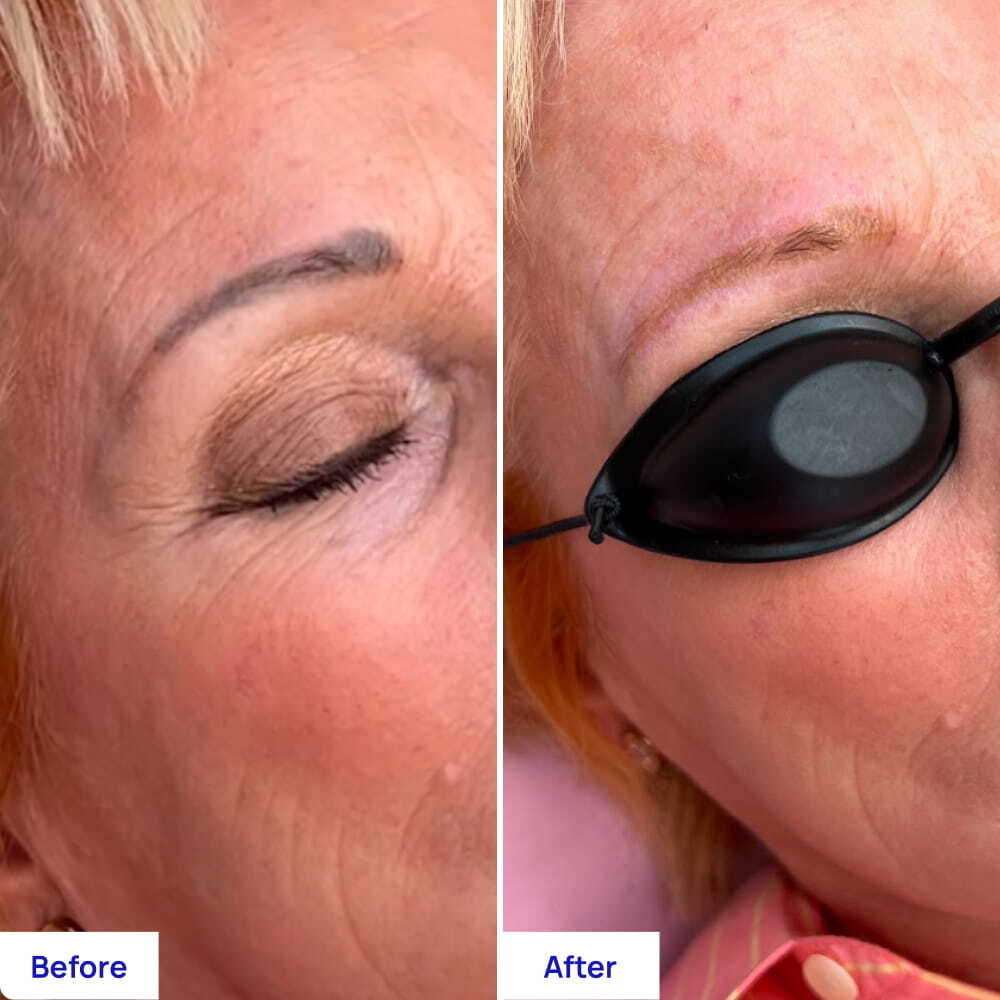 Before After Slide 3
