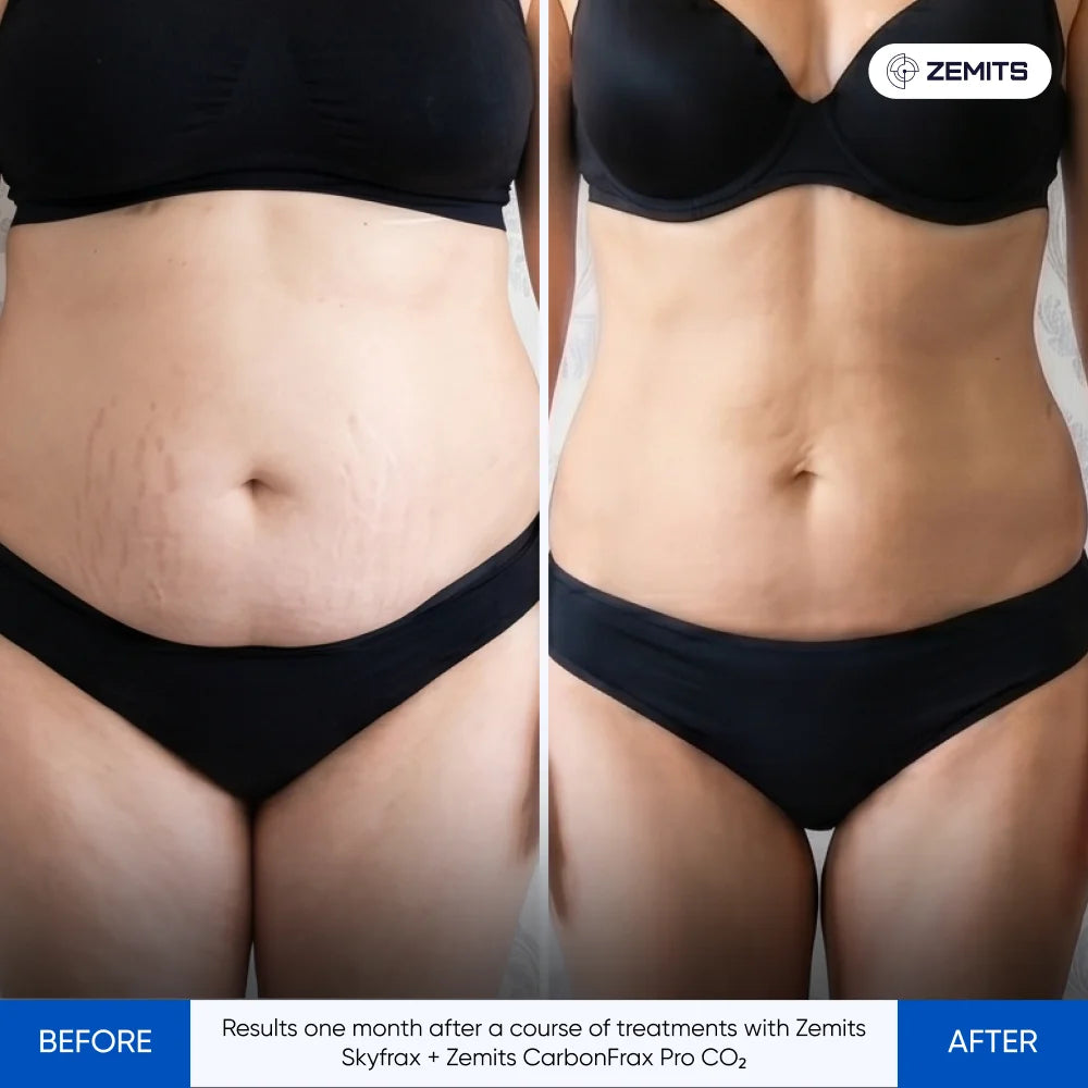 Before After Slide 1