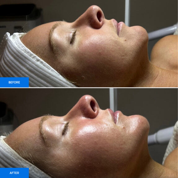 Before After Slide 1