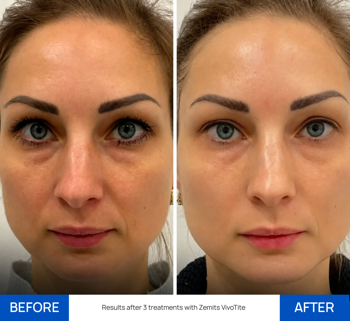 Before After Slide 1