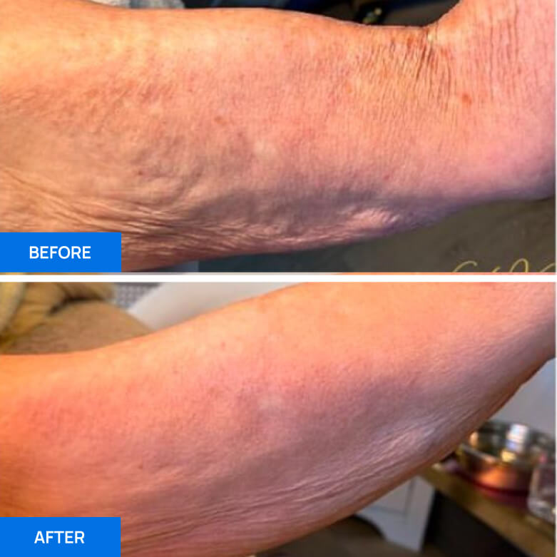 Before After Slide 1