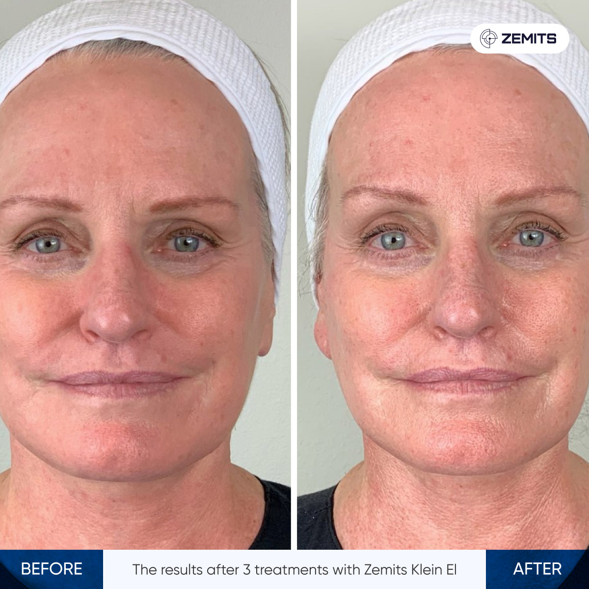 Before After Slide 5