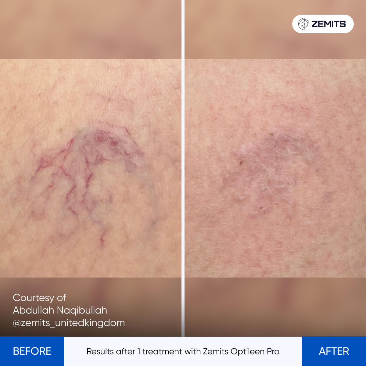 Before After Slide 4