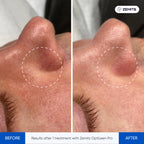 Zemits OptiLeen Pro