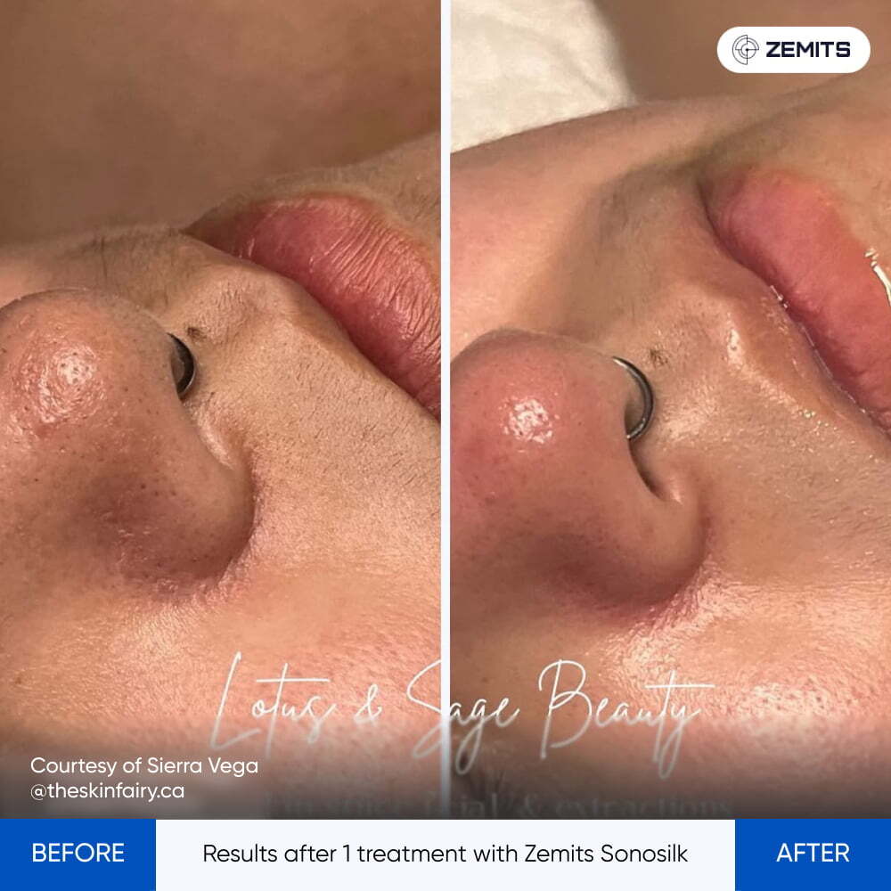 Before After Slide 1