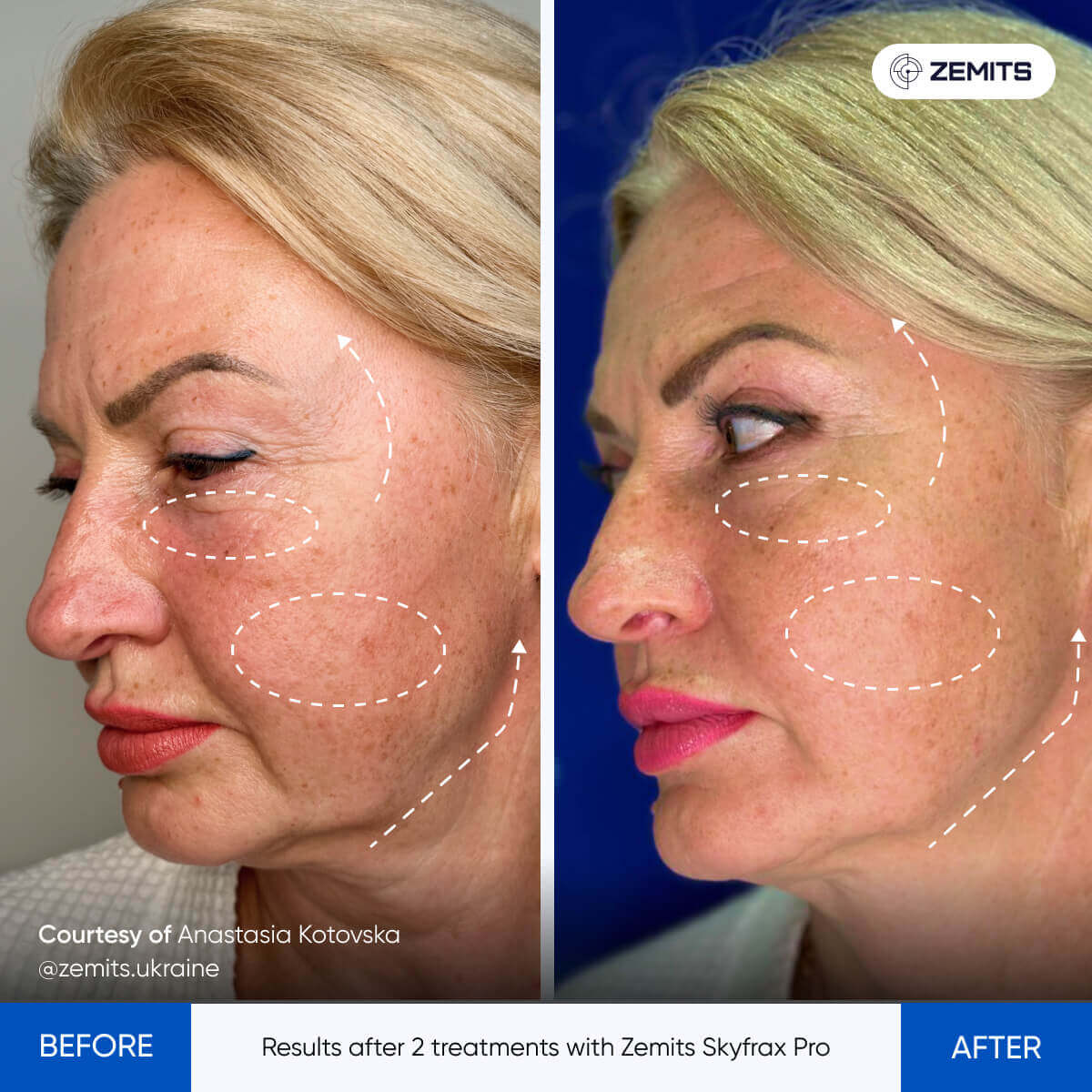 Zemits SkyFrax Pro Fractional Radiofrequency Microneedling for