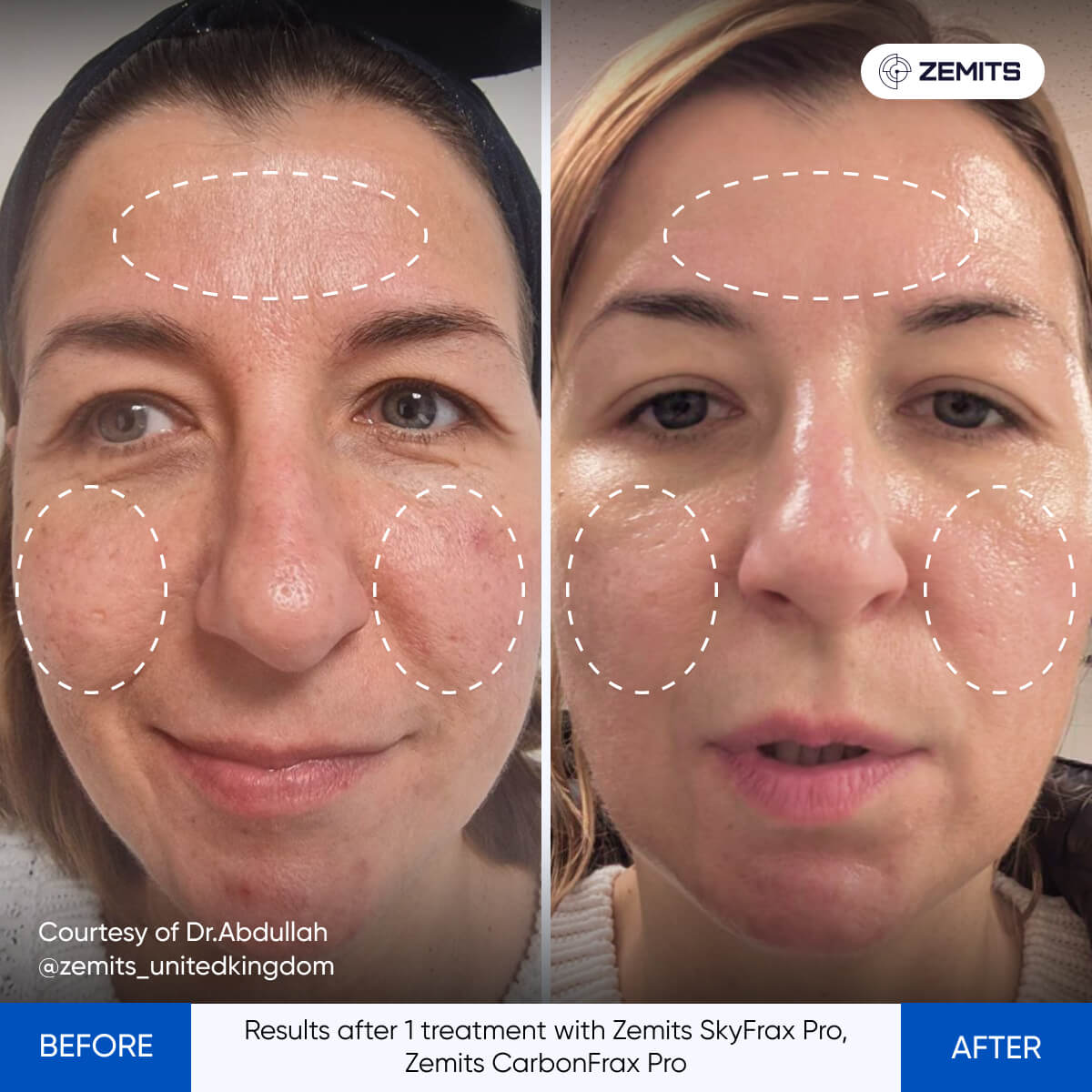 Zemits SkyFrax Pro Fractional Radiofrequency Microneedling for