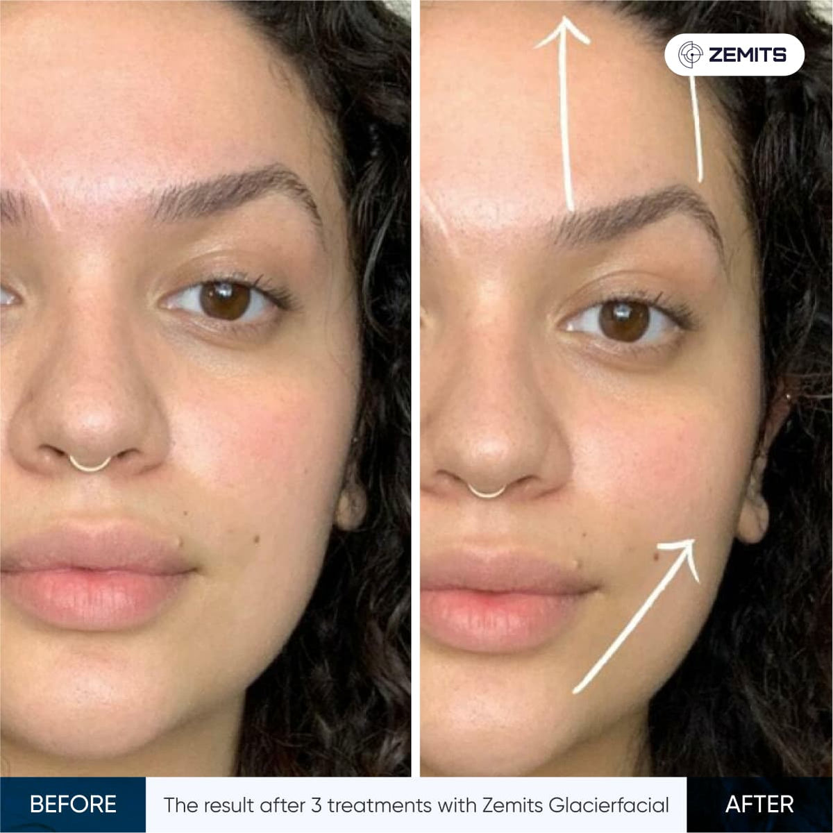 Before After Slide 1