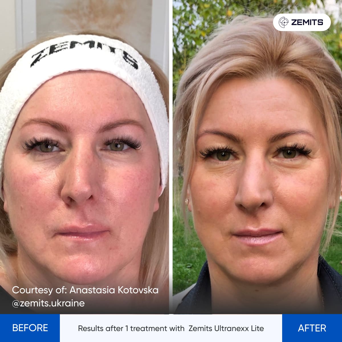 Before After Slide 6
