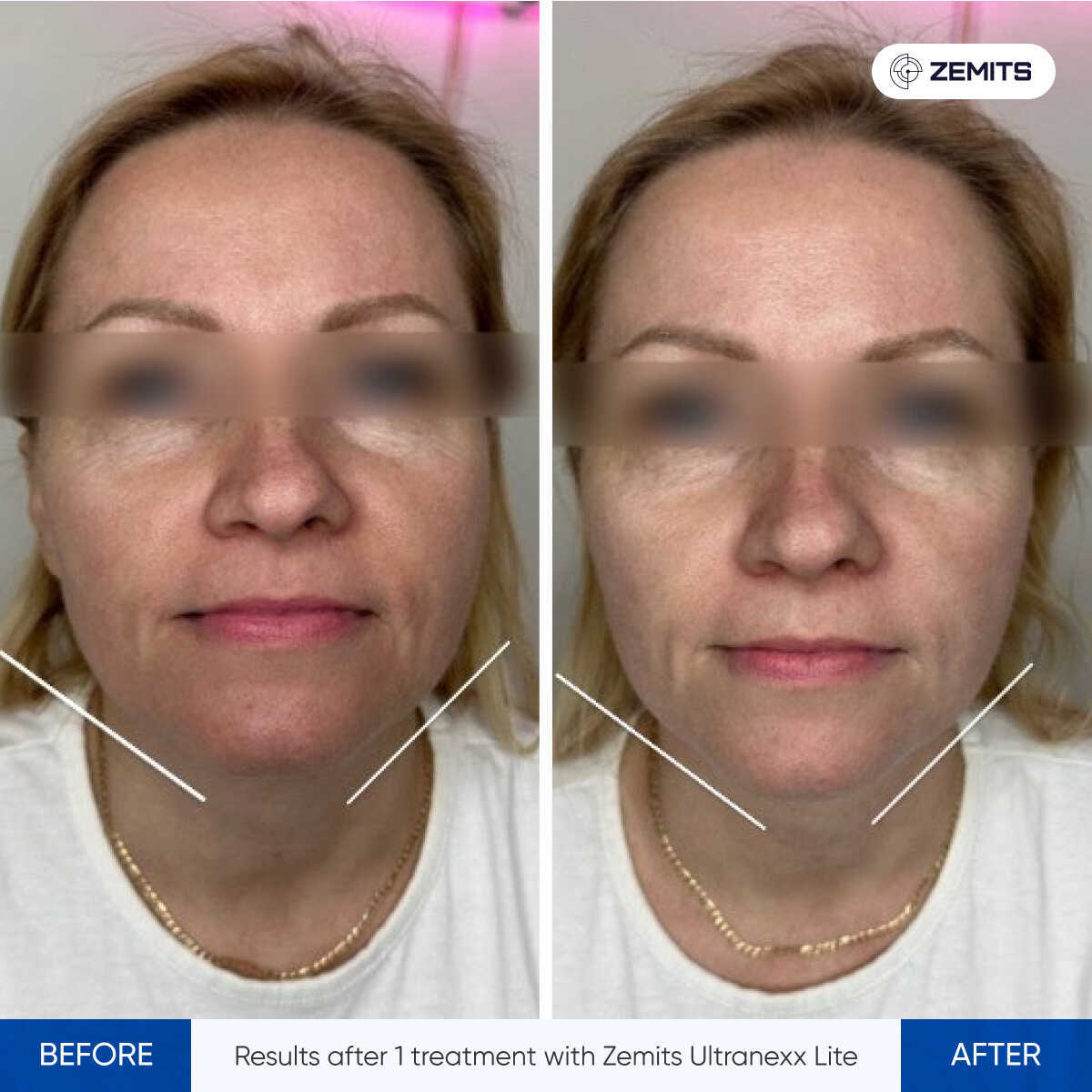 Before After Slide 2