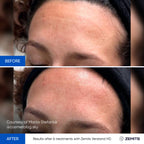 Zemits Verstand HD PRO