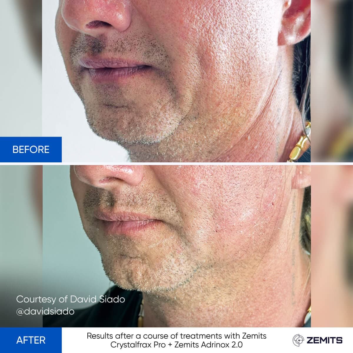Before After Slide 1