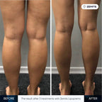 Zemits LipoPremo